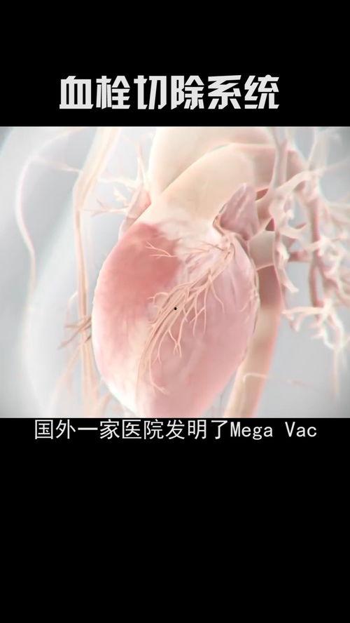 消除血栓的视频,揭秘血管畅通的神奇之旅