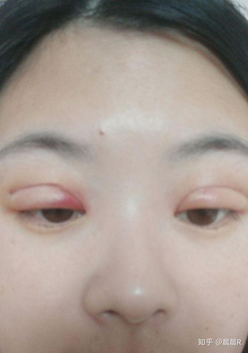 修复双眼皮视频过程,从术前准备到术后恢复